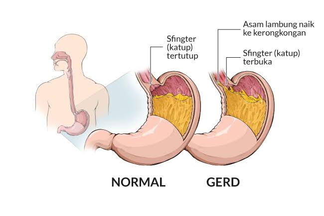 Mengapa terjadi gerd? 